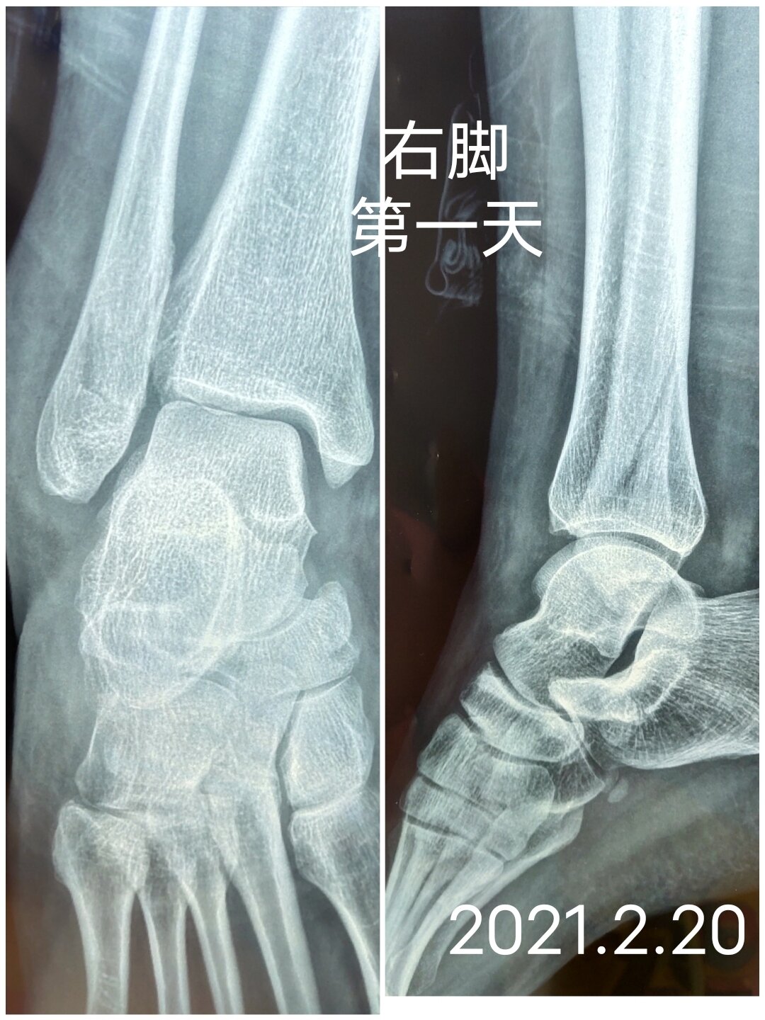 瓦尔兰右脚骨折需要缺席一段时间